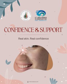 Bad skin days happen—but they don’t define you.

Be patient with your skin, gentle with yourself, and remember that confidence isn’t about perfection—it’s about acceptance.
We’re in this together 💙

#AcneAwarenessMonth #SkinHealth #Dermatology #SkincareEducation #HealthySkin