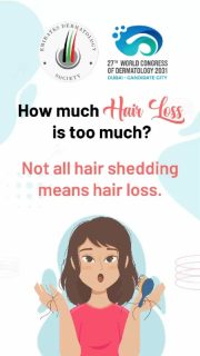 Finding a few hairs in your brush or shower is usually part of the normal hair cycle. But when shedding becomes sudden, excessive, or persistent, it may be time to take a closer look. 👀
⚠️ Noticeable thinning, a widening part, bald patches, or changes to the scalp can all be signs that deserve attention.
🩺 Hair loss can have many causes — and identifying the cause is the first step toward the right treatment.
This Alopecia Awareness Month, let’s learn to recognize the difference between normal shedding and hair loss that needs evaluation. 💙
#AlopeciaAwarenessMonth #HairLossAwareness #Alopecia #Dermatology #HealthyHair HairHealth EDSociety EmiratesDermatologySociety