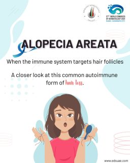 Sudden, patchy hair loss can be concerning — but understanding alopecia areata is the first step toward recognizing it and seeking the right care.
🧬 Alopecia areata is an autoimmune condition that targets hair follicles and can cause hair loss on the scalp, eyebrows, eyelashes, beard, and other areas.
The course can vary from person to person, and early dermatological assessment can help guide appropriate management. 🩺
Swipe through our carousel to learn about the signs, causes, course, and treatment options for alopecia areata.
💙 This September, let’s raise awareness and remind those experiencing hair loss that they are not alone.
#AlopeciaAreata #AlopeciaAwarenessMonth #HairLossAwareness #Alopecia #Dermatology #AutoimmuneDisease #HairHealth #EDSociety #EmiratesDermatologySociety