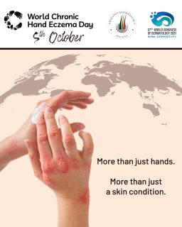 🖐️ World Chronic Hand Eczema Day

Chronic Hand Eczema is more than a skin condition — it can impact everyday activities, work, and quality of life.

Today, the Emirates Dermatology Society joins the global dermatology community in raising awareness, promoting early recognition, and supporting better care for those living with CHE.

Let’s raise awareness. Let’s understand. Let’s support. 💙

#WorldChronicHandEczemaDay #ChronicHandEczema #CHE #EczemaAwareness #Dermatology #EmiratesDermatologySociety #EDS #SkinHealth