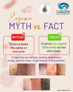 There is no single “eczema look.” Symptoms can appear differently across skin tones, which is why awareness and accurate recognition matter.
Listen to lived experiences and remember: skin conditions are not always easy to see or understand from the outside. 💙
#InclusiveSkincare #EczemaAwarenessMonth #SkinToneMatters #EczemaFacts